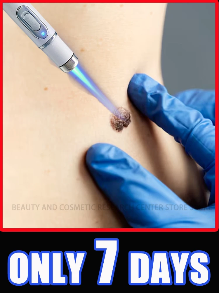 

Ручка для удаления бородавок 2025 года — безопасная и эффективная, автоматически отпускает бородавки