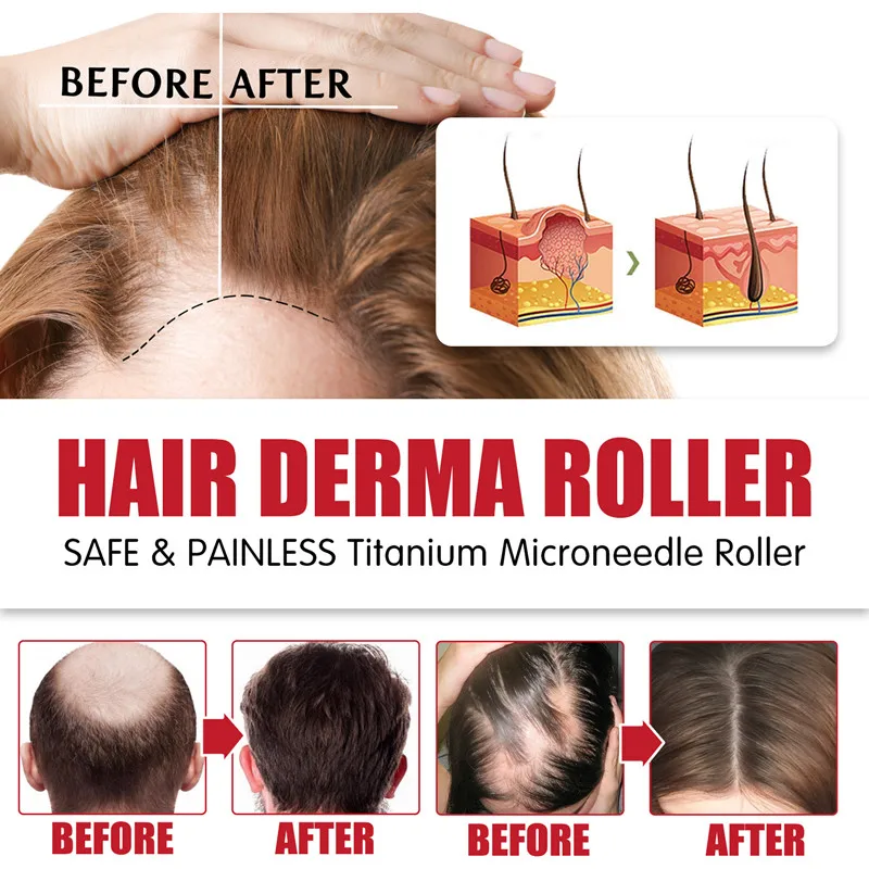 Men Tự Nhiên Mọc Râu Derma Roller DRS 540 Micro Kim Dermaroller Lông Mọc Chống Rụng Tóc Trị 0.2/0.25/0.3Mm