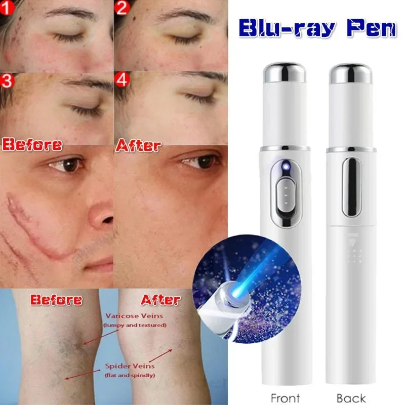 Anti-acne Laser Pen Facial Clean Skin Spots Removal Anti Wrinkle Home Use Beauty Devices Anti Varicose Spider Vein Treatment