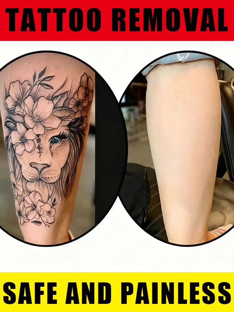 Effective in removing permanent tattoos