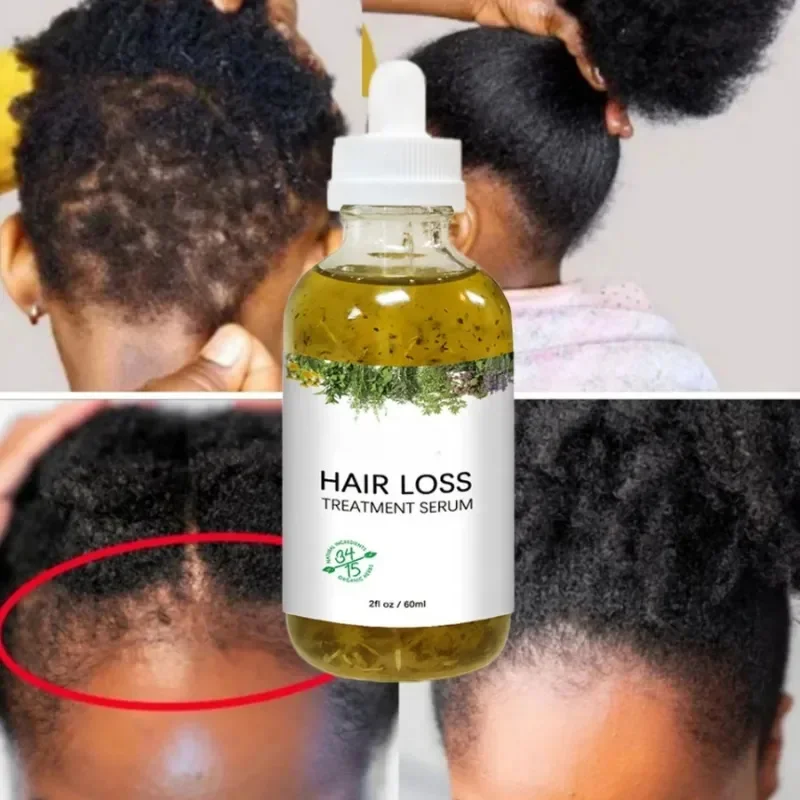 Soro de crescimento rápido do cabelo africano louco tração alopecia anti perda de cabelo óleo essencial evitar calvície reparação do couro cabeludo cuidados com o cabelo 60ml