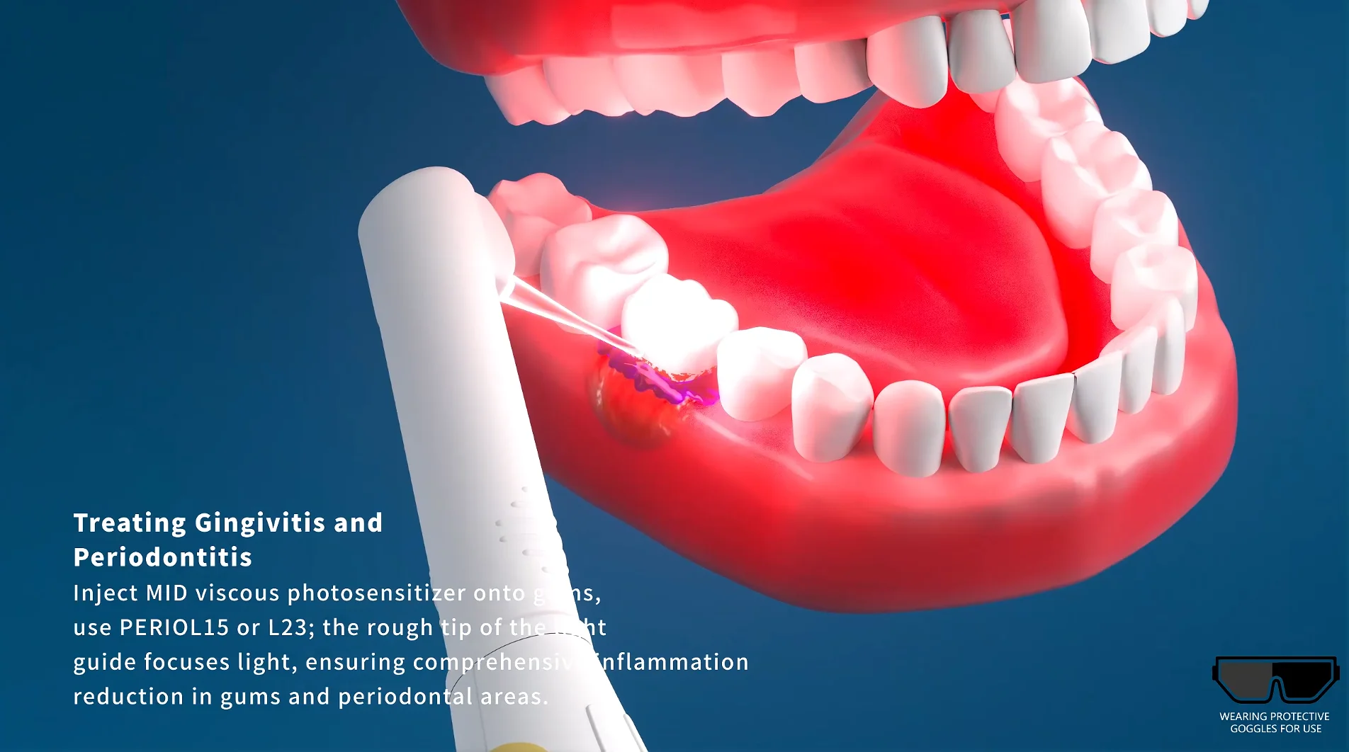 EASYINMSILE endodontic files rotary dental files Periodontal Photodynamic Therapy Device Used to treat dental inflammation