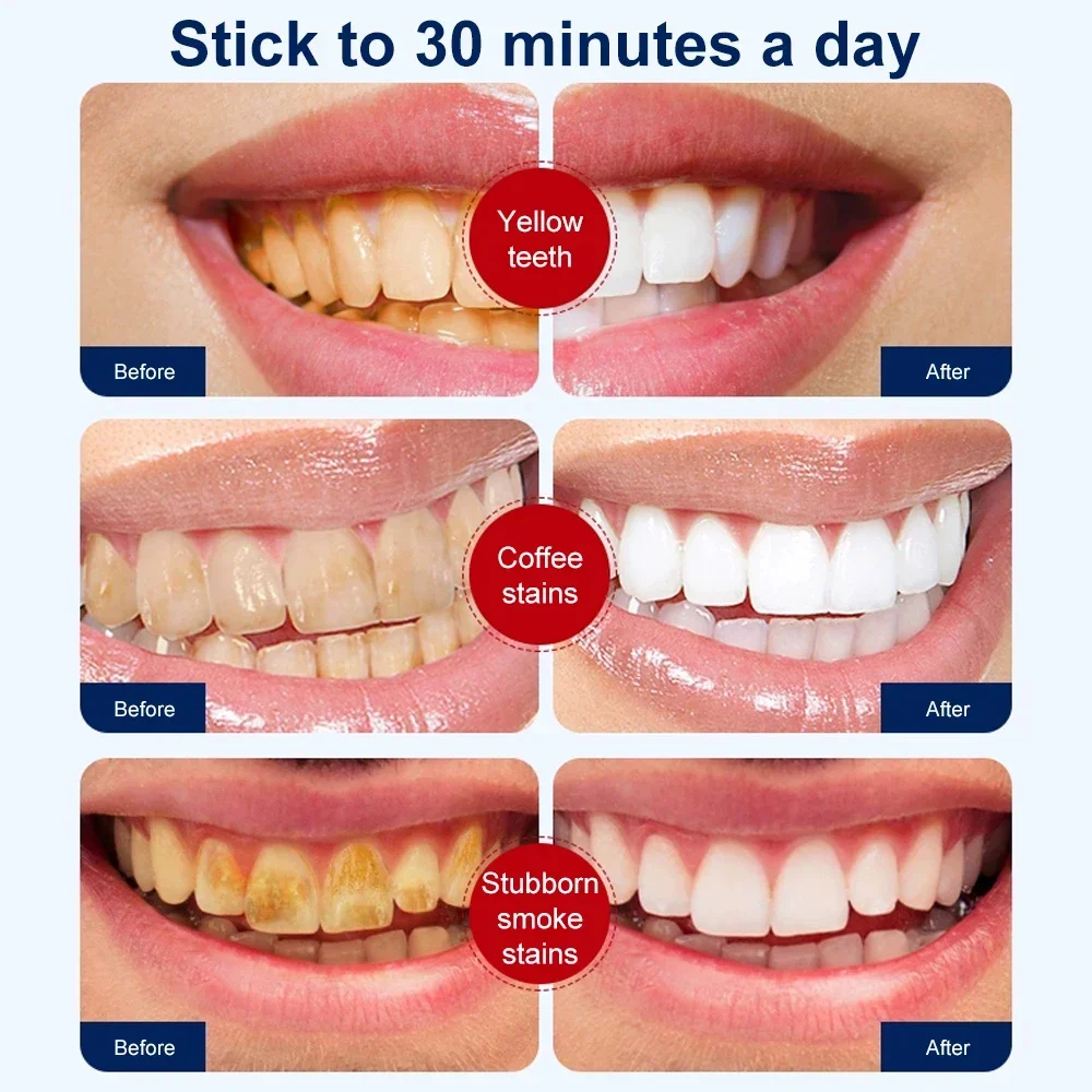 14 Stuks 5d Tanden Whitening Strips Tandpasta Gel Mondhygiëne Reiniging Tandheelkundige Bleken Elastische Patches Valse Tanden Fineer Zorg