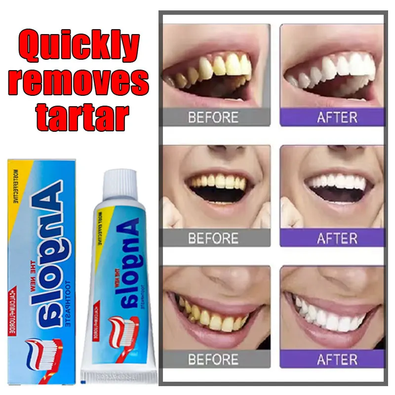 

Remover Dental Calculus Toothpaste RemoveYellow Teeth Bad Breath Cleaning Plaque ToothStain Whitening Preventing Periodontitis