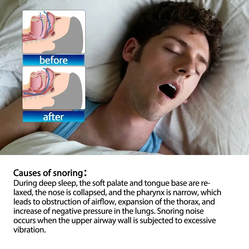 Anti-Snoring Patch Right Way Stop Snoring Help lmproved Nighttime Sleeping Less Mouth Breath Adult Snore Care Stickers