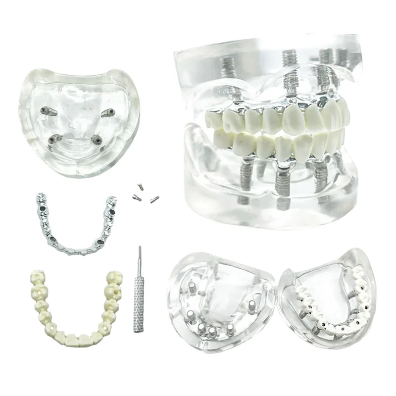 Dentistry Model Implant Restoration Model Maxillary Removable Overdenture Model With 4 Implants Dentist Students Education Model