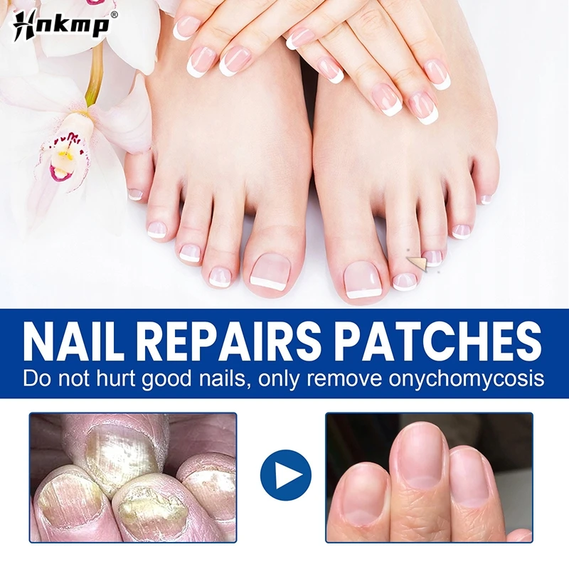 60Pcs Toenail Fungus Patch Sticky Nail Repair Patch Nail Ingrown Correction Sticker Toenail Care Paronychia Nail Treatment Patch