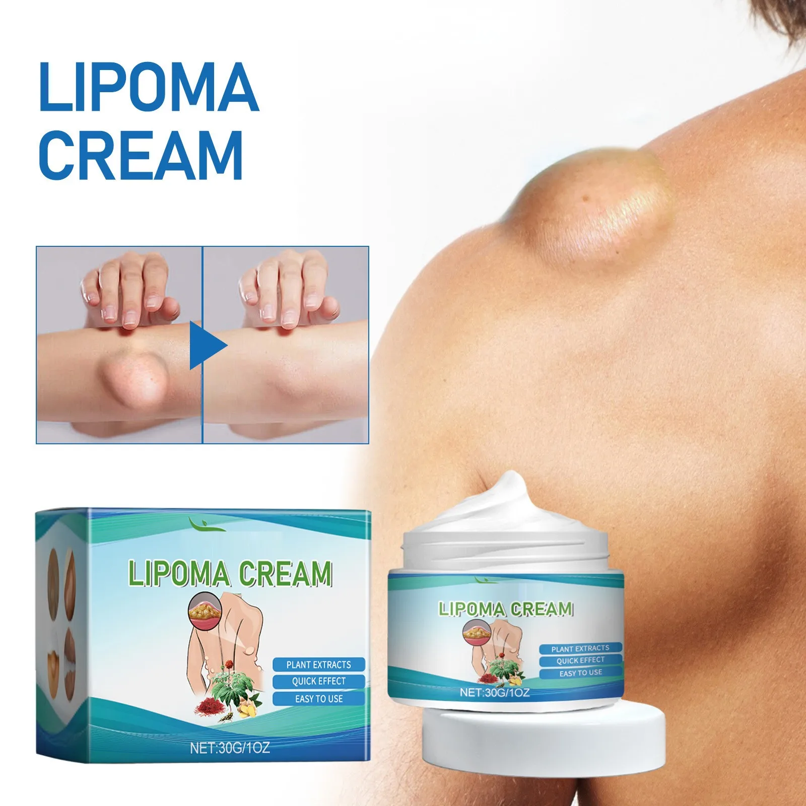 Nowa maść do usuwania lipoma, pasta do usuwania lipoma, naturalna ziołowa pasta do usuwania lumpów, pasta do usuwania lipoma 30g/1oz