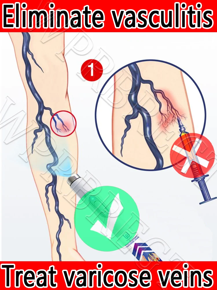 

Precision treatment: Say goodbye to the pain of varicose veins