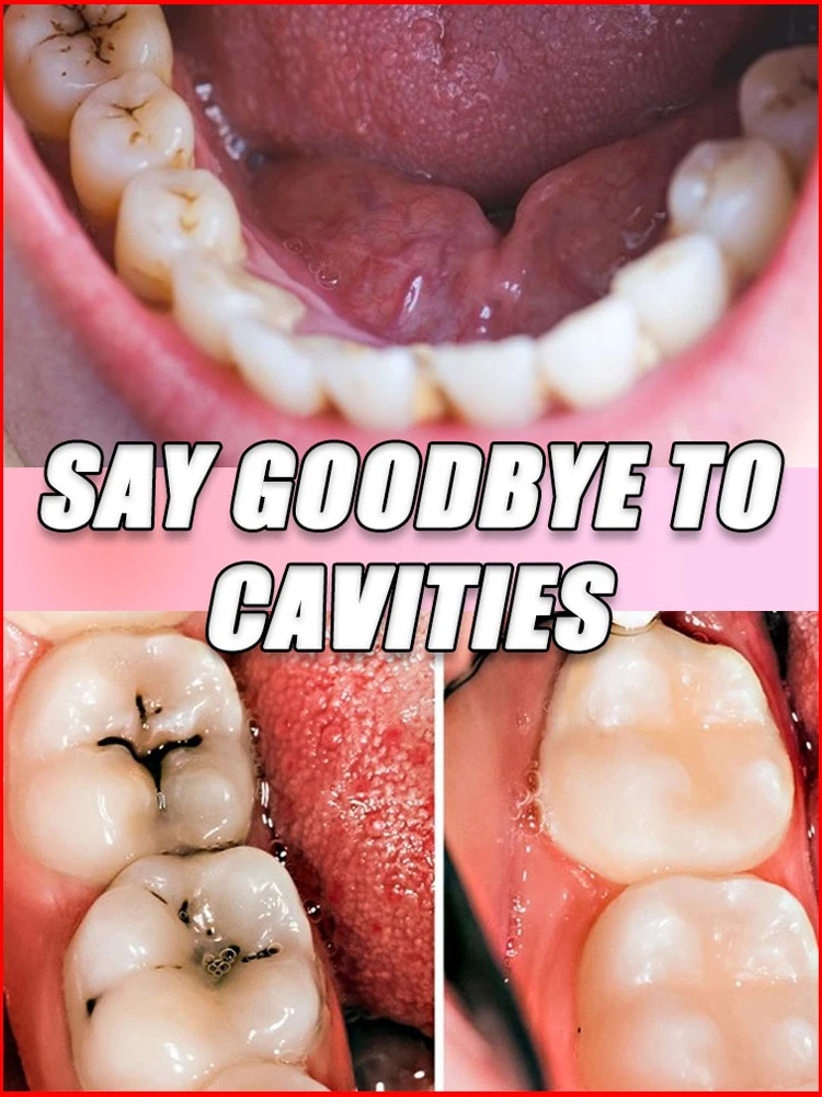 Anti-Cavity Repair Tooth Decay