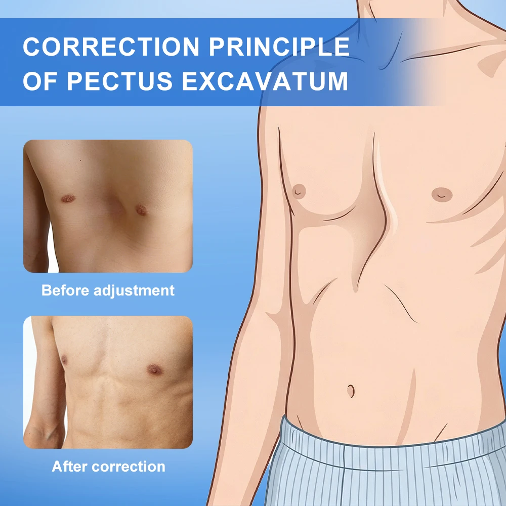 Pectus Excavatum Orthosis Brace Sternal Depression Thoracic Sunken Sternum Support  Funnel Chest Orthopedic for Adults Children