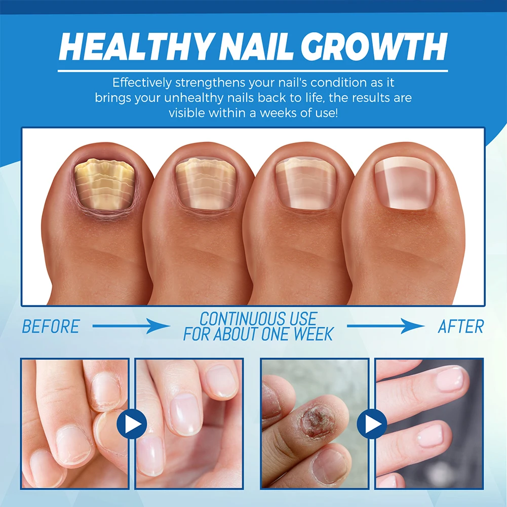 قلم إصلاح جل الأظافر الفطري ، مضاد للفطريات ، الضوء الأزرق ، فطار الأظافر ، بدون ألم ، مصل إزالة محمول ، منتجات إصلاح القدم ، ساخن #5
