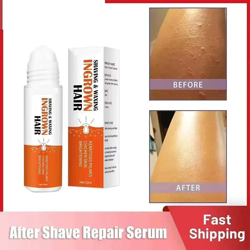 Razor Bumps Removal Solution Ingrowns Hair treatment Kit After Shave Repair Dark Spot Reduce Redness Serum for vanish PFB Pimple