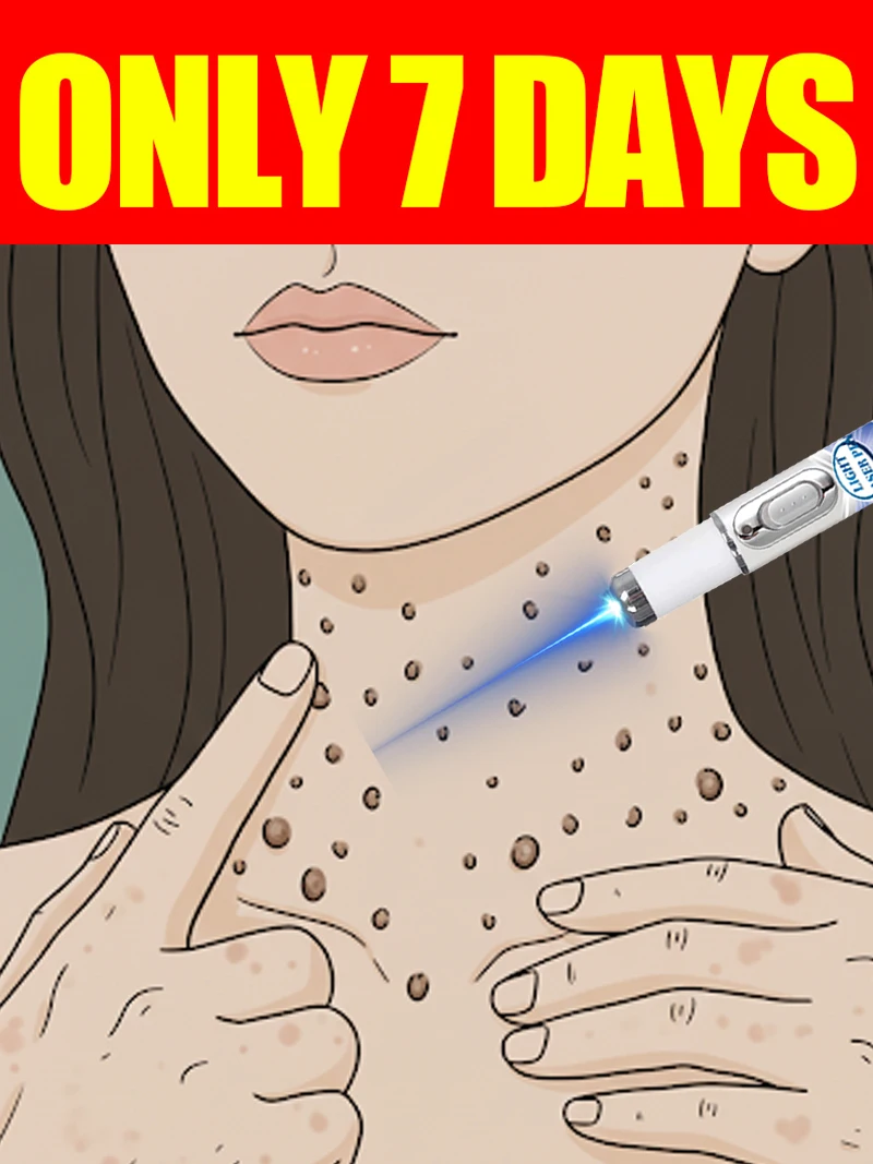 

2025 New Upgrade Blue Laser Solve Wart Tool