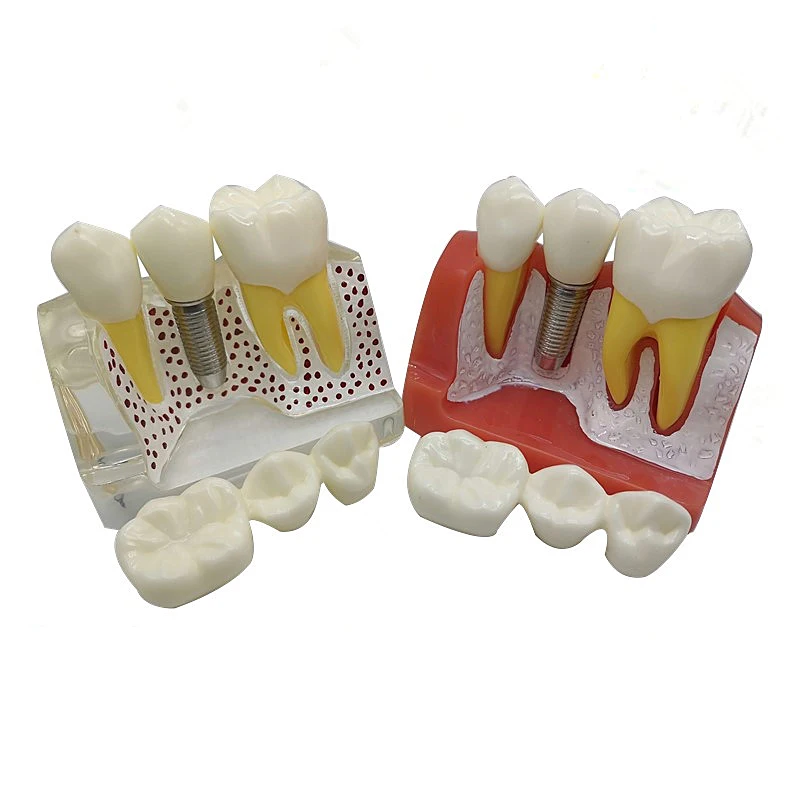 Modèle de plantation dentaire 4 fois, analyse de modèles de dents, pont de couronne, modèle amovible, enseignement dentaire, modèle de recherche