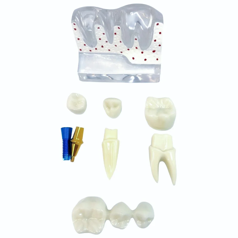 Dental Implant Pathology Demonstration Model Transparent Base Detachable Crown Bridge Abutment for Patient EducationConsultation