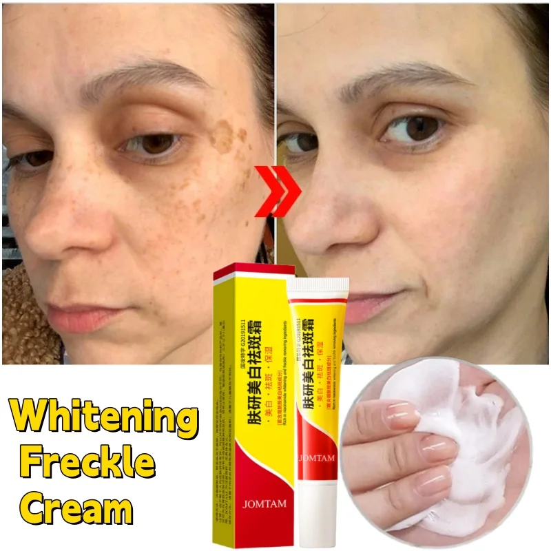 

Effective Whiten Freckle Cream Remove Dark Spot Melasma Fade Melanin Anti-Pigmentation Improve Dullness Brighten Face Skin Care