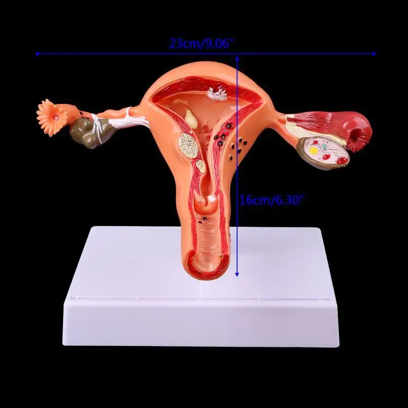 Medical Anatomy Model Pathological Uterus Ovary Cross Section Study Tool Free Shipping