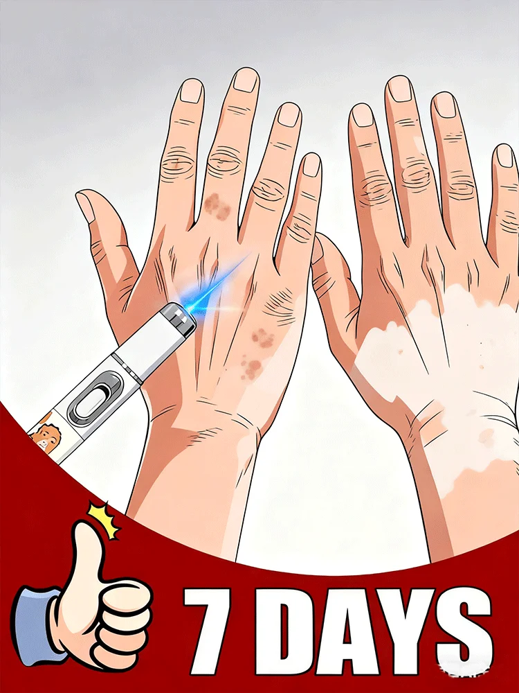 

2025 New Blue Laser care Vitiligo