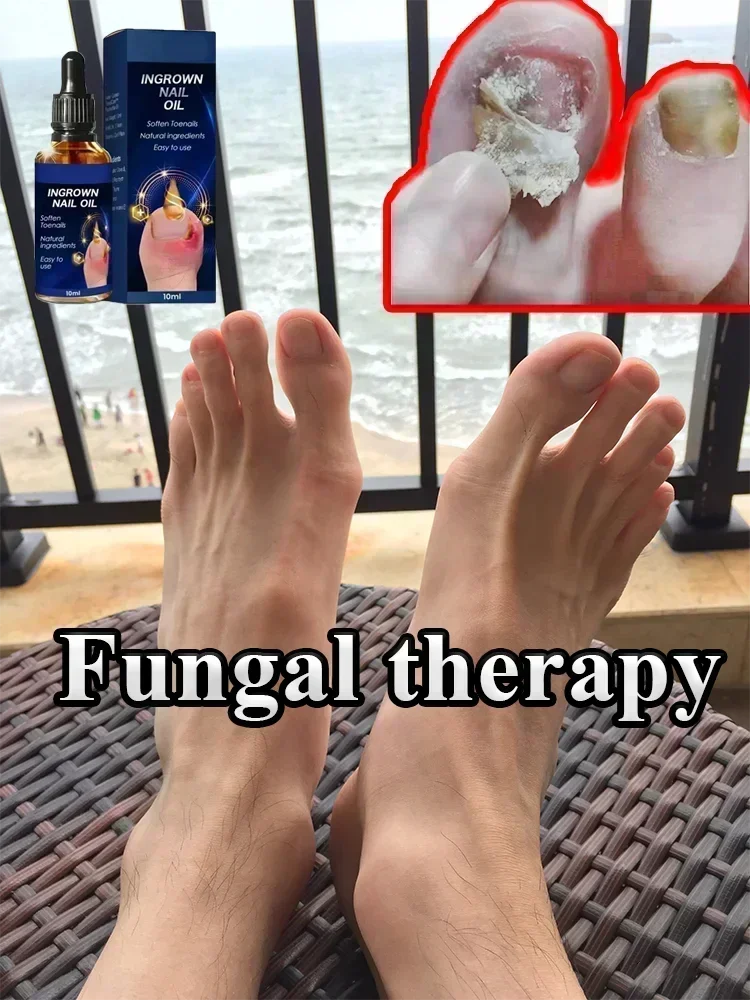 Жидкость для удаления грибка на 7 дней, лечение грибковых ногтей, онихомикоз, инфекция, восстановление ног, забота о яркости ногтей