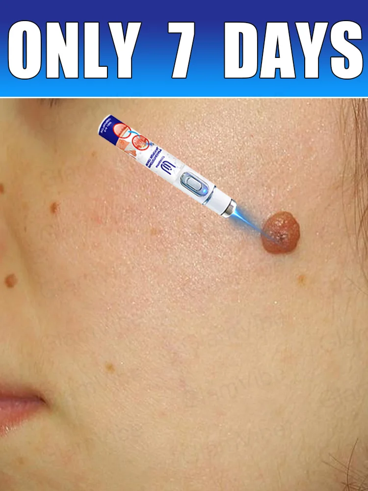 

blue light pen solve warts, hot sale wart care tools