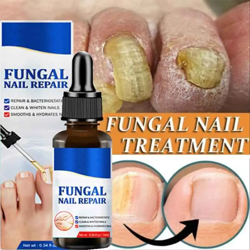 Fungal Nail Treatment Oil Foot Repair Essence Toe Nail Fungus Removal Gel Anti Infection Cream Fungal Nail Removal 10ML