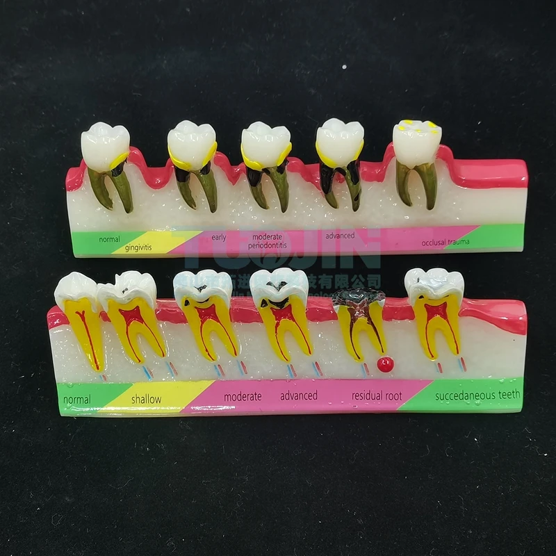 Dental Model Teeth Periodontal Disease Model Assort Demo Caries Model Dentist Teaching Training Doctor-patient Communication