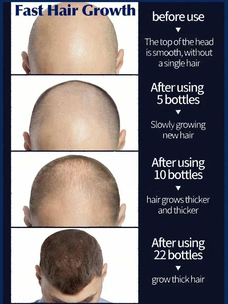 Fast Hair Growth Hair Growth Oil Effective Baldness Repair Hereditary Hair Loss Postpartum Seborrheic