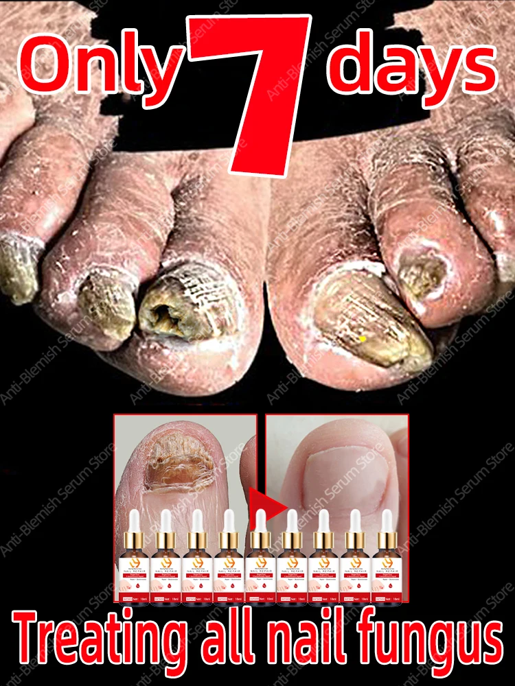 Solve all nails problems