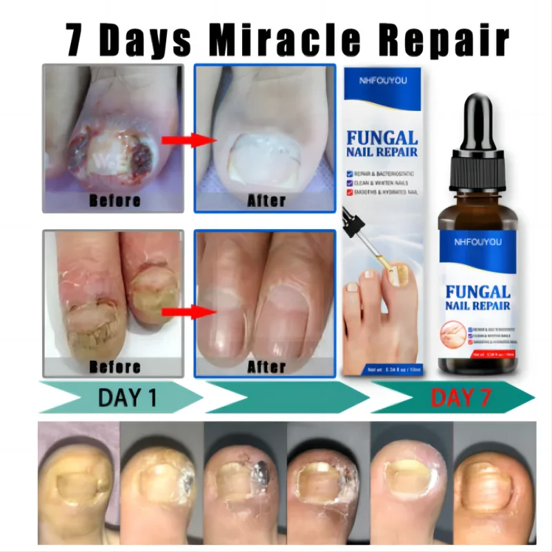 8Nail Fungals Renewal Nail Repair Liquid for Discolored Thickened Crumbled Nails Nail Fungals for Discolored Broken Cracked BSV8