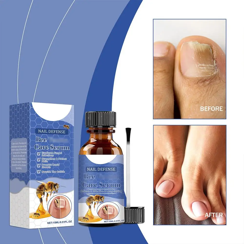 15ml Bee Care Serum Foot Treatment Solution Professional Toe Nails Repair Nail Care Solution For Toe nail E0B4