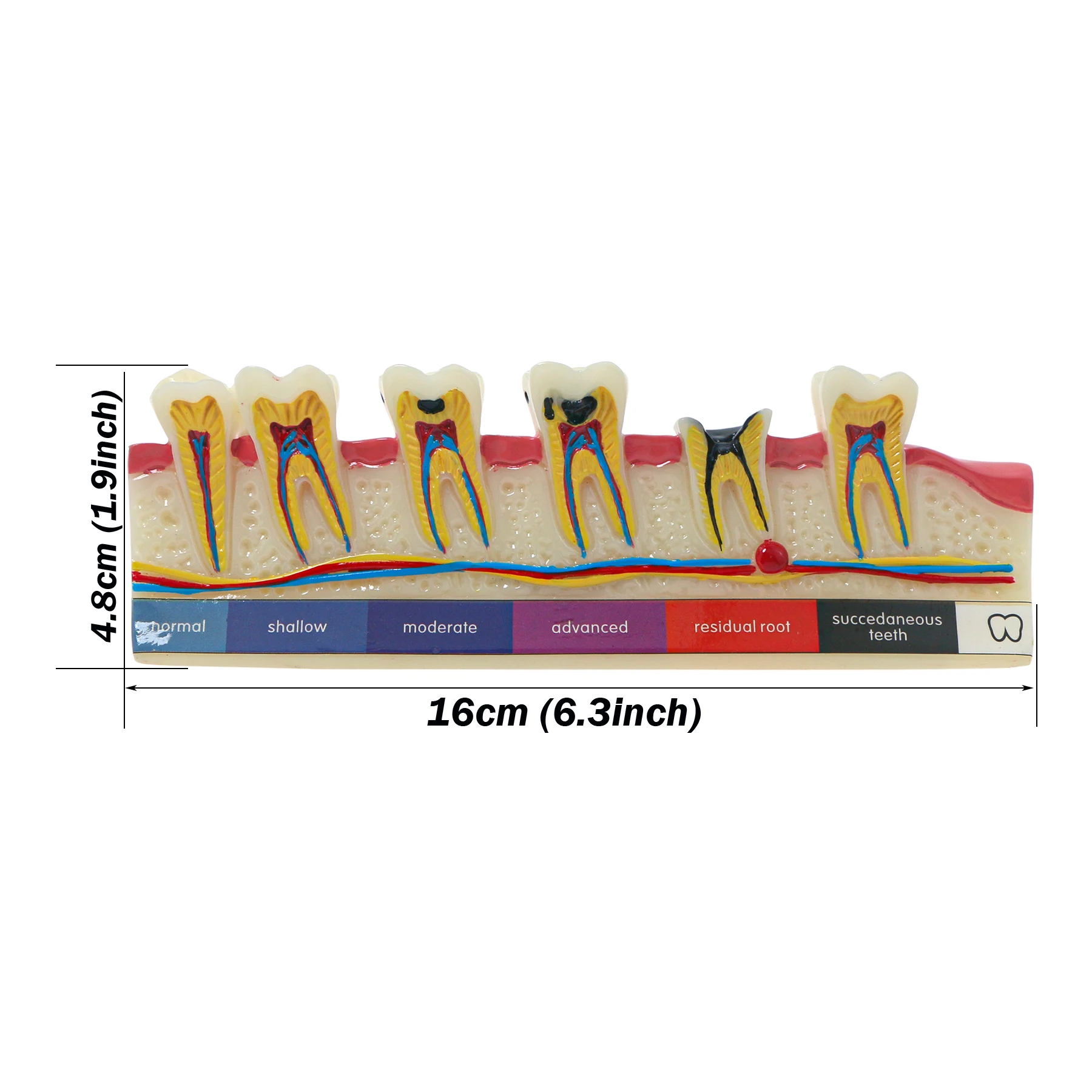 Dental Caries Disease Model M4017 Teeth Periodontics 5-Stage Perio Assort Demo 1/5PCS