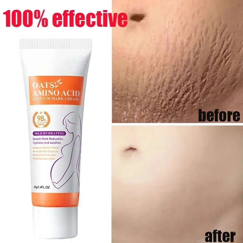 Scar Restore Postoperative body scar repair Cream Moisturizing Repairing Smoothing Body Skin Suitable for All Skin Types