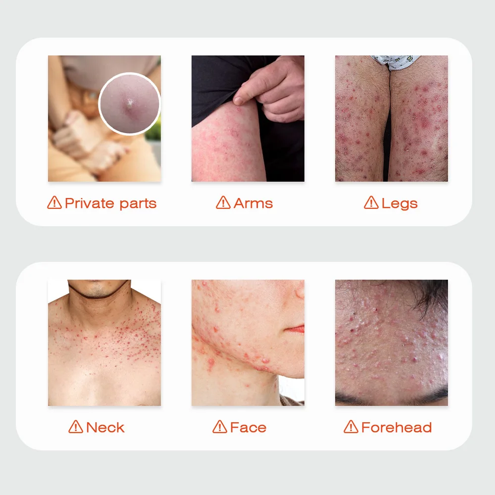 Body Acne Removal Cream Treatment Face Butt Back Acne Marks Smooth Repair Chicken Skin Cream Moisturizing Whitening Skin Care - view 2