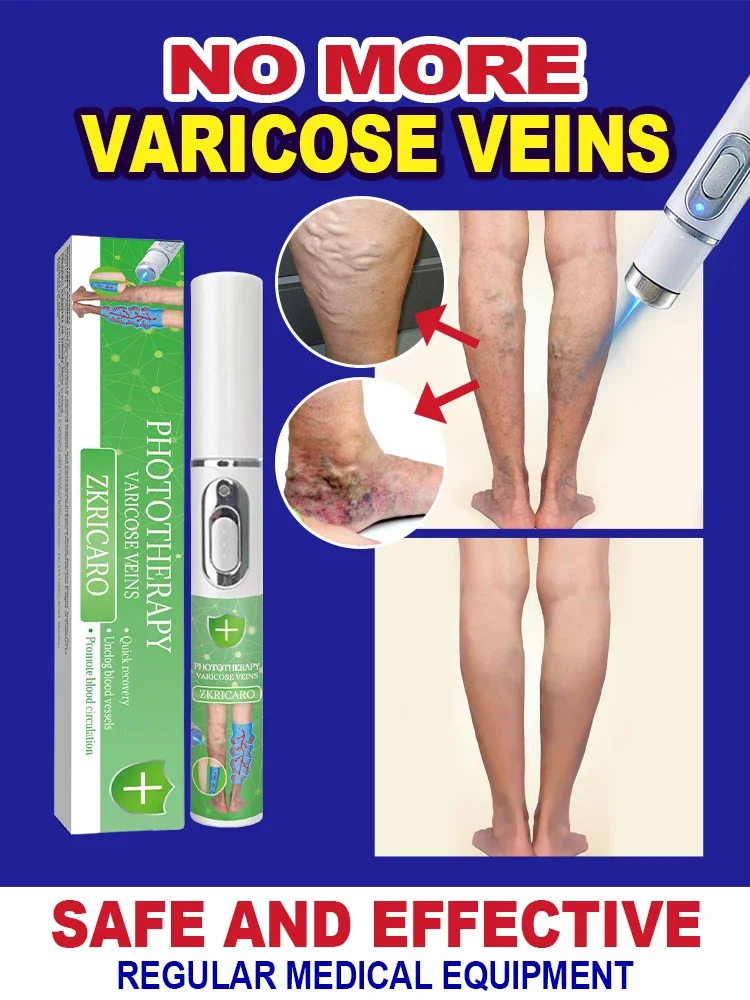 Intravenous laser treatment can improve moderate varicose veins, effectively unclog and permanently eliminate varicose veins