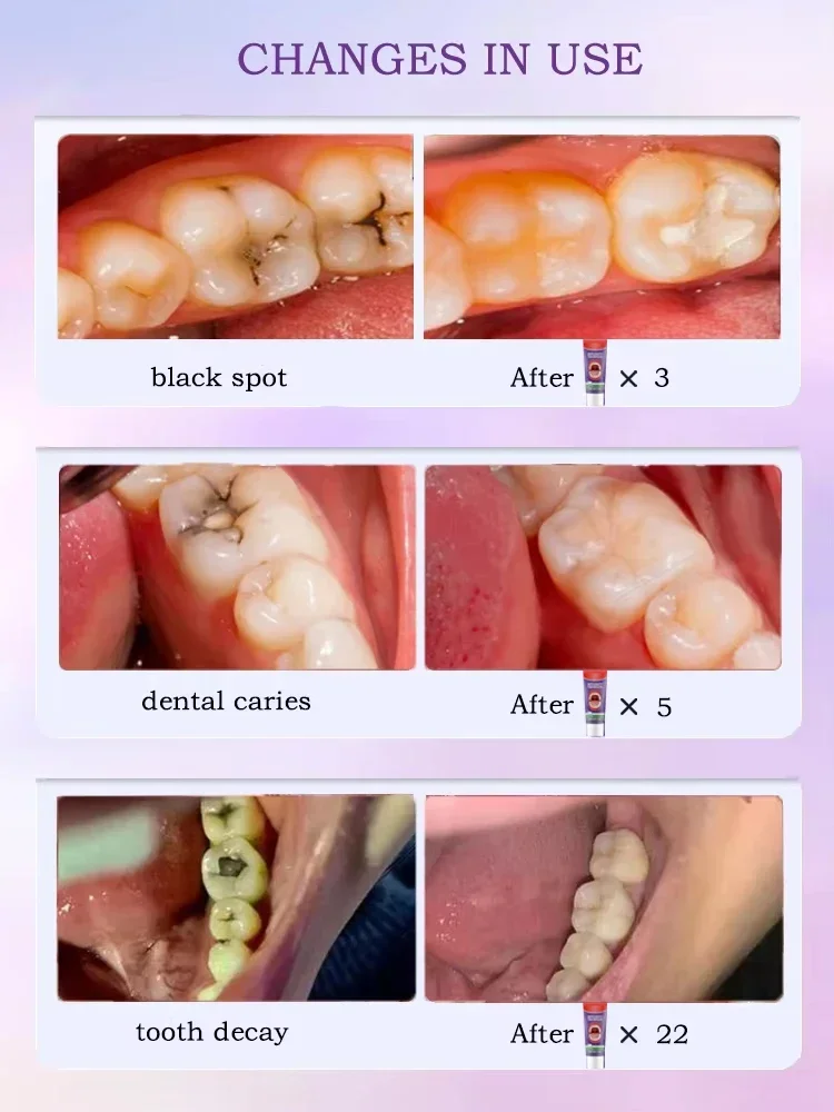 Anti Caries Repairing Cavities Tooth Decay Repair