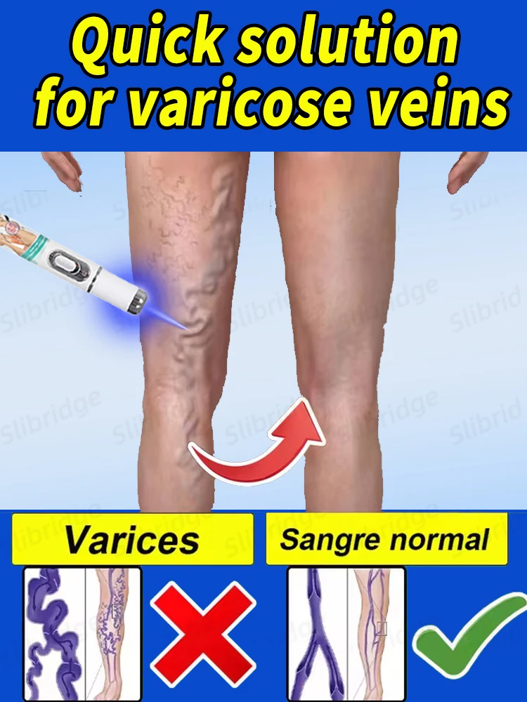 

Using nanotechnology to deeply remove varicose veins, phlebitis and spider legs