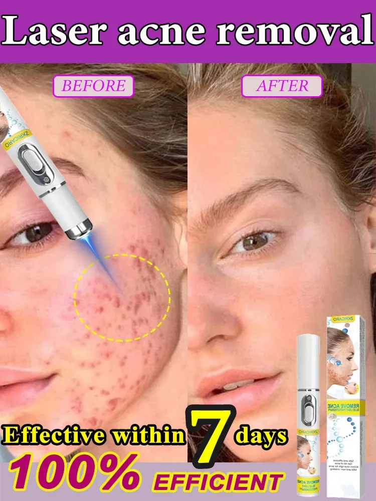 laser recover Acne marks hot selling