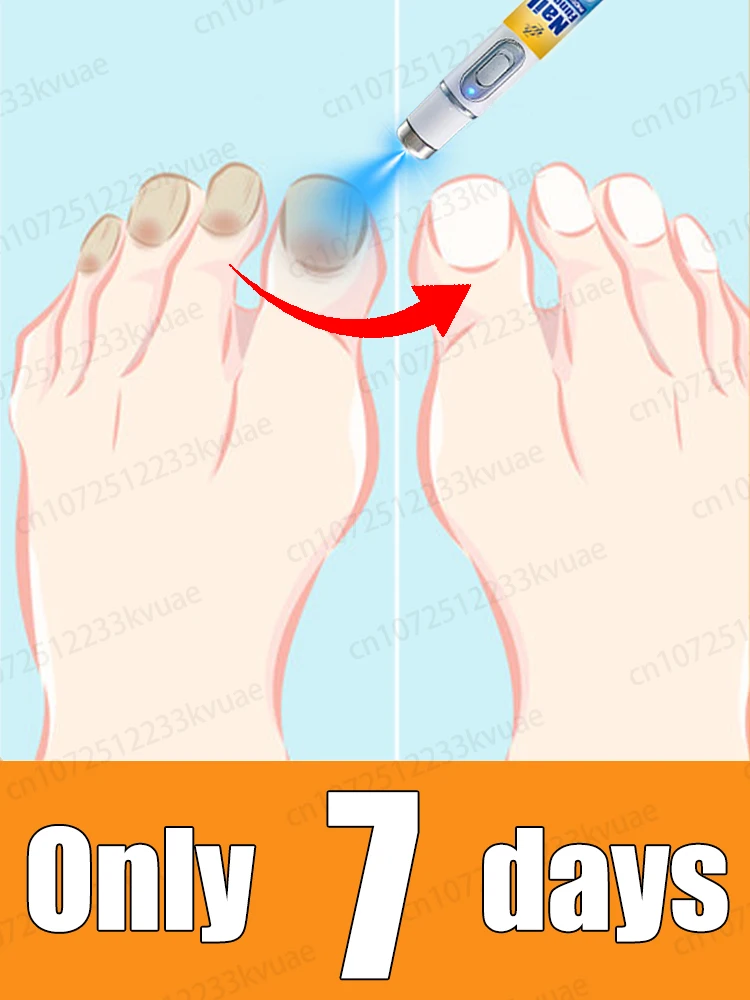 

Second generation 7 days to say goodbye to onychomycosis