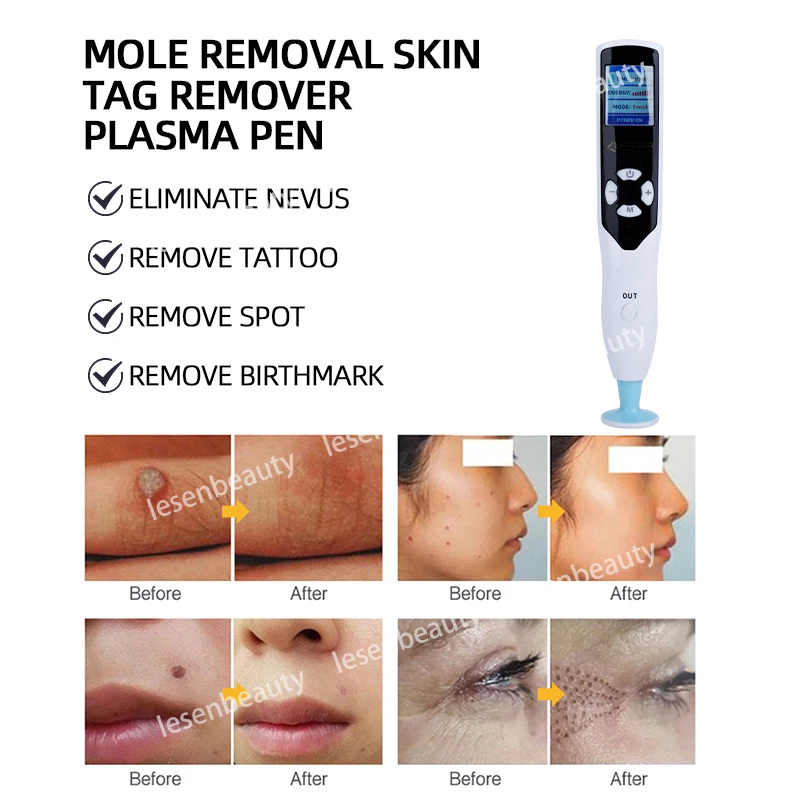 Ozon Plasma Pen Ooglid Opheffen Wrat Sproet Verwijdering Fibroblast Tattoo Skin Tag Mole Verwijdering Donkere Vlek Rimpel Verwijderaar 2 In 1