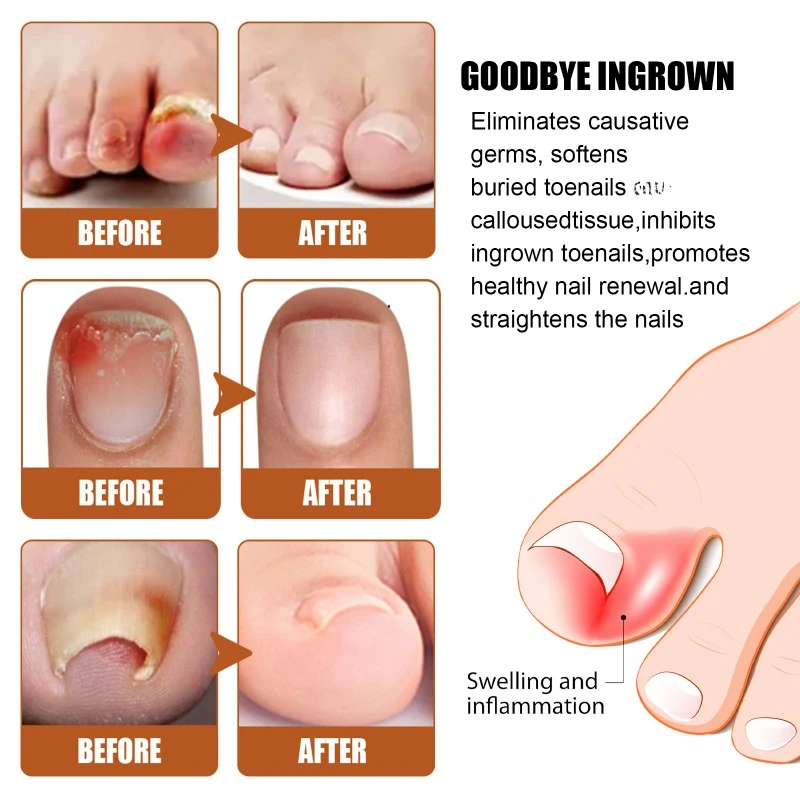 Anti-nail groove relief Essential oil repair ingrown toenail onychomycosis Fungal Treatment thickening soft nails Infection care