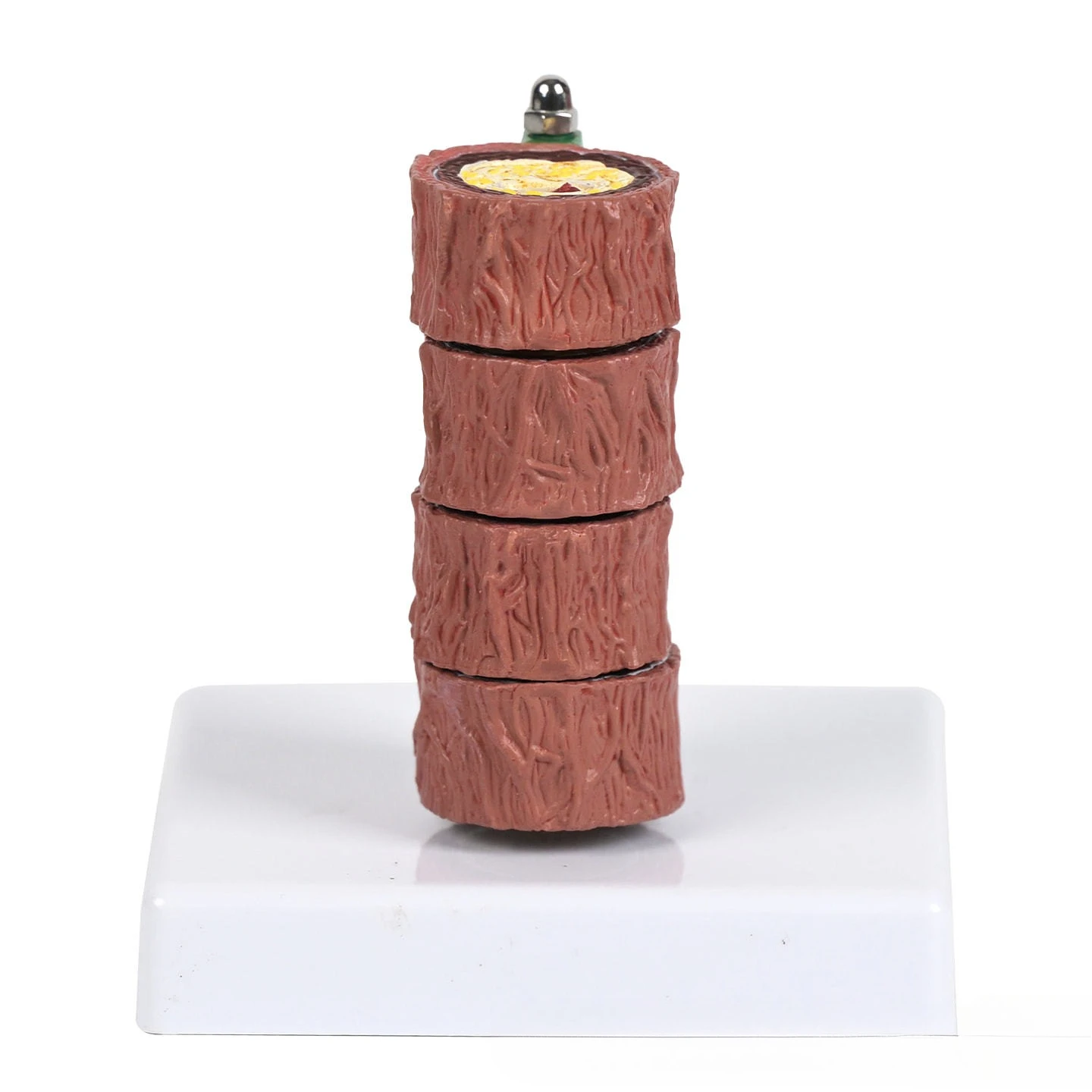 Four-stage arteriovenous vascular model anatomical model of staged lesions