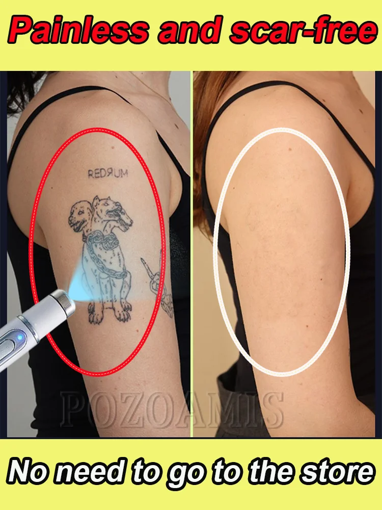 Painless and scar-free, available in various sizes and patterns