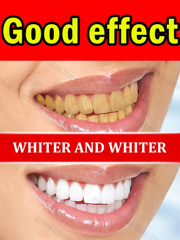 

Teeth Cleaning Deep Tartar Stains