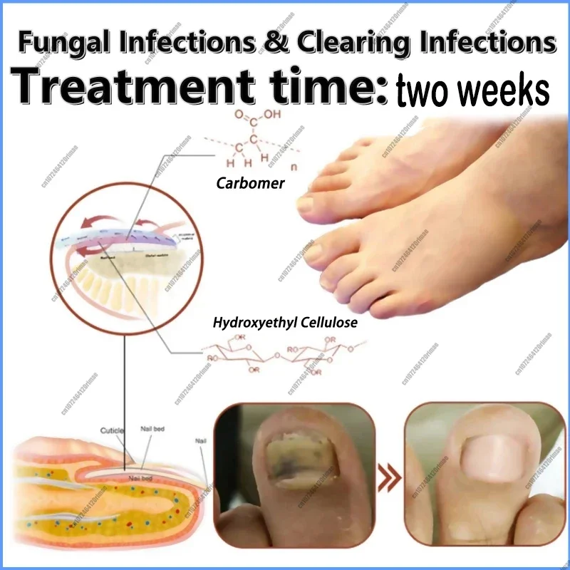 Schimmel Nagel Laser Apparaat Reparatie Snelle Nagels Schimmel Onychomycosis