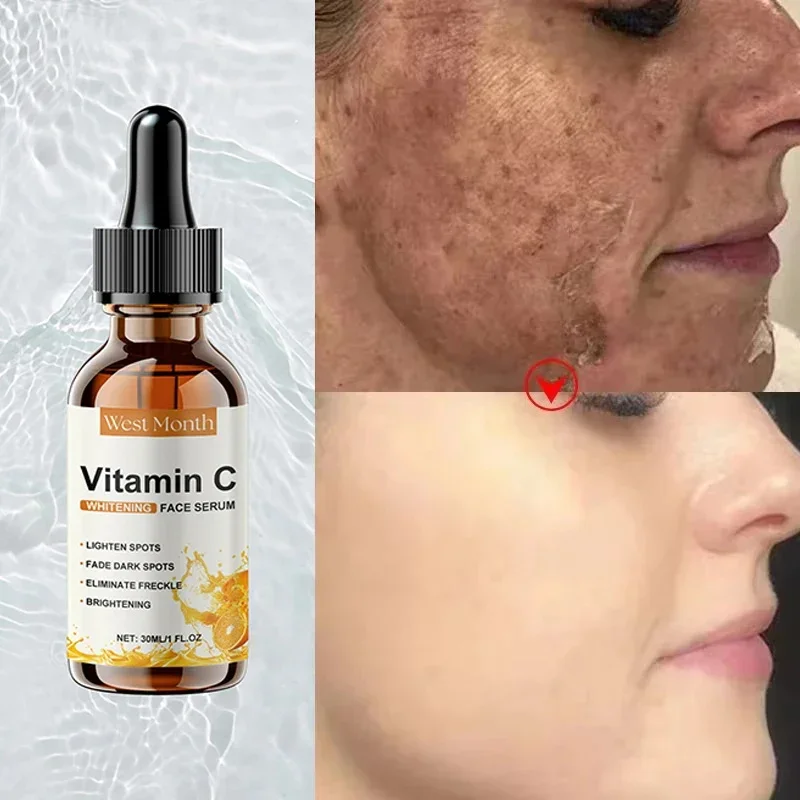 Vitamin C Whitening Serum Entfernen Sommersprossen Dunkle Flecken Gesicht Essenz Verblassen Melasma Melanin Aufhellen Reparatur Stumpfe Hautpflege Kosmetik