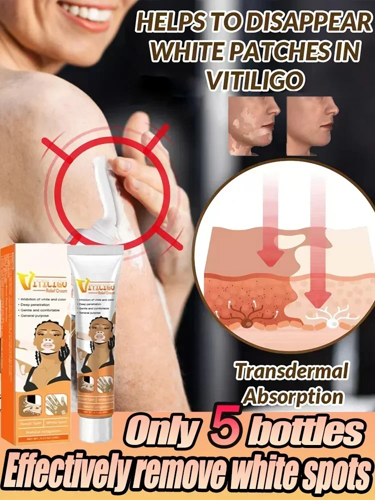 Pomada de Vitiligo con extracto de hierbas, elimina el tiña, eliminación de manchas blancas, cuidado de la piel, Vitiligo, elimina el Vitiligo 1006