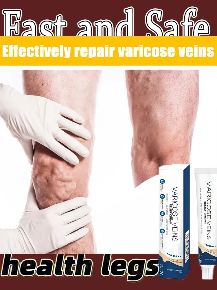 °°°Varicose Veins Treatment Cream Remove Red Blood Streaks Varicocele Vasculitis Phlebitis Strengthen Capillary Health