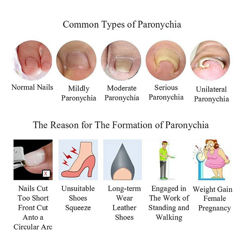 PARON-Ingrown Toenail Ferramenta Pedicure, Endireitamento Clip, Curvo Bbs Brace, Grosso, Paroníquia Correção, 40Pcs por Garrafa