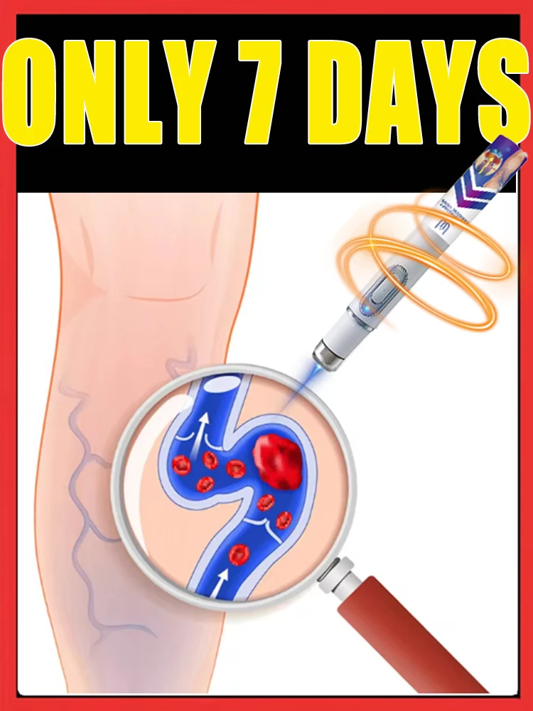 

Generation-2 Laser Says Goodbye To Spider Legs Varicose In 7 Days